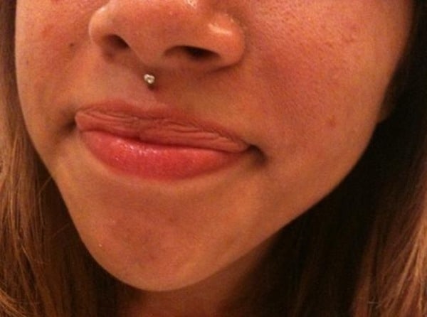 medusa piercing scar